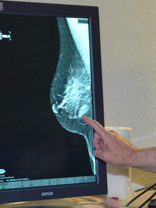 UTMB-radiologist-points-to-a-suspicious-mass-in-ultrasound-breast-image