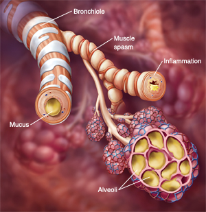 Chronic Obstructive Pulmonary Disease (COPD)