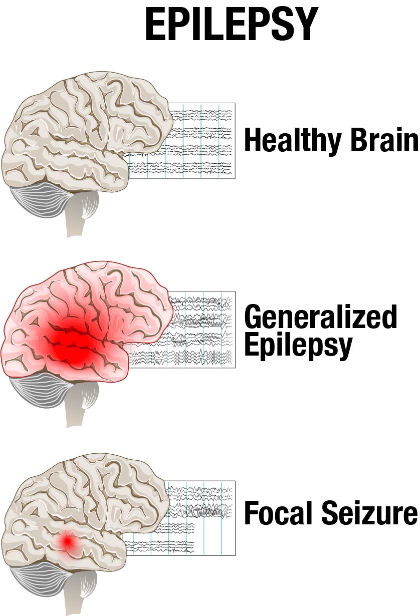 epilepsy on eeg vs normal