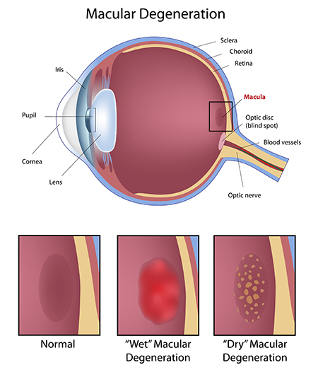 Macular Degeneration medical diagram