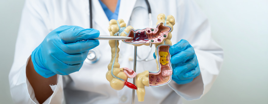 Closeup of anatomy model showing intestine, appendix, and digestive system for ulcerative colitis treatment