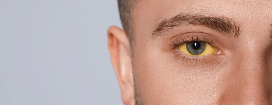 Closeup of man’s eyes with yellow sclera