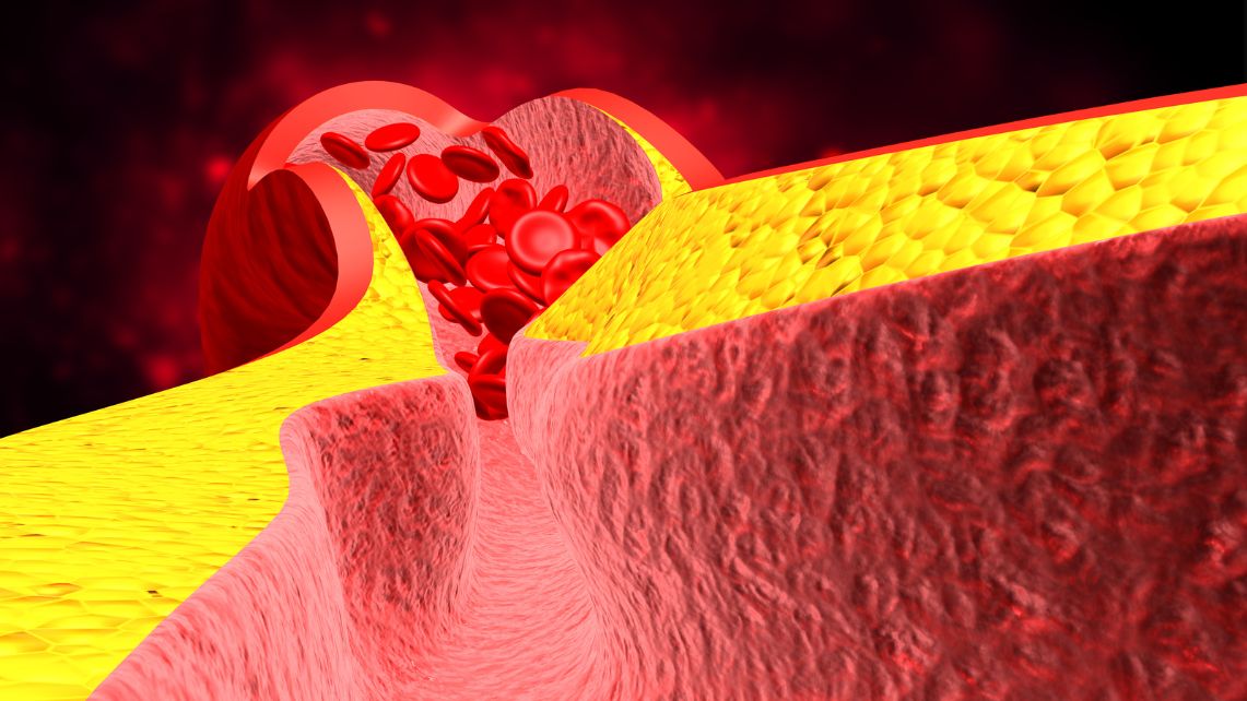 artist rendition of a vein narrowing and blood cells clogging up