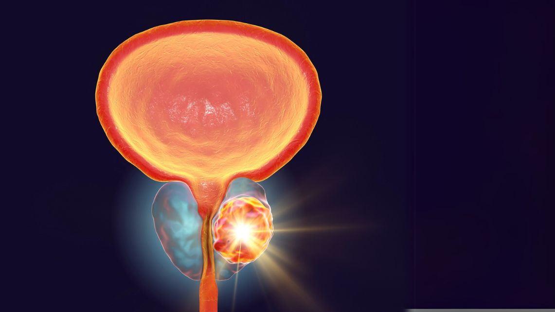 An image of a blader, prostate and urethra with prostate cancer