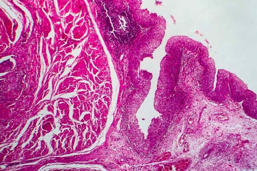 A slide of bladder cancer